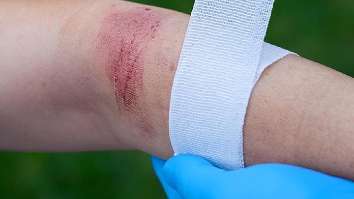 不宁腿综合征：病因、症状与治疗方法全解析
