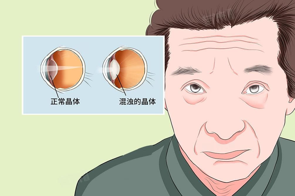白内障手术后多久能恢复