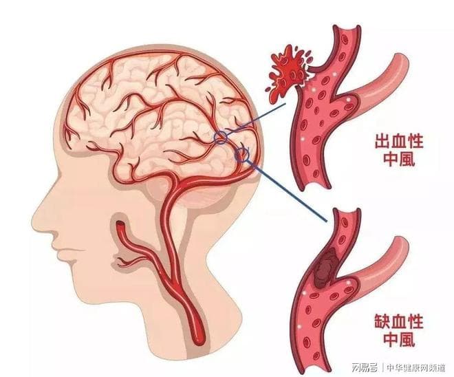氢气为什么可以治疗脑梗？安全性如何？
