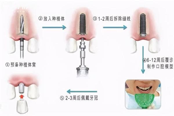 种植牙过程详解：从术前评估到最终修复的完整指南
