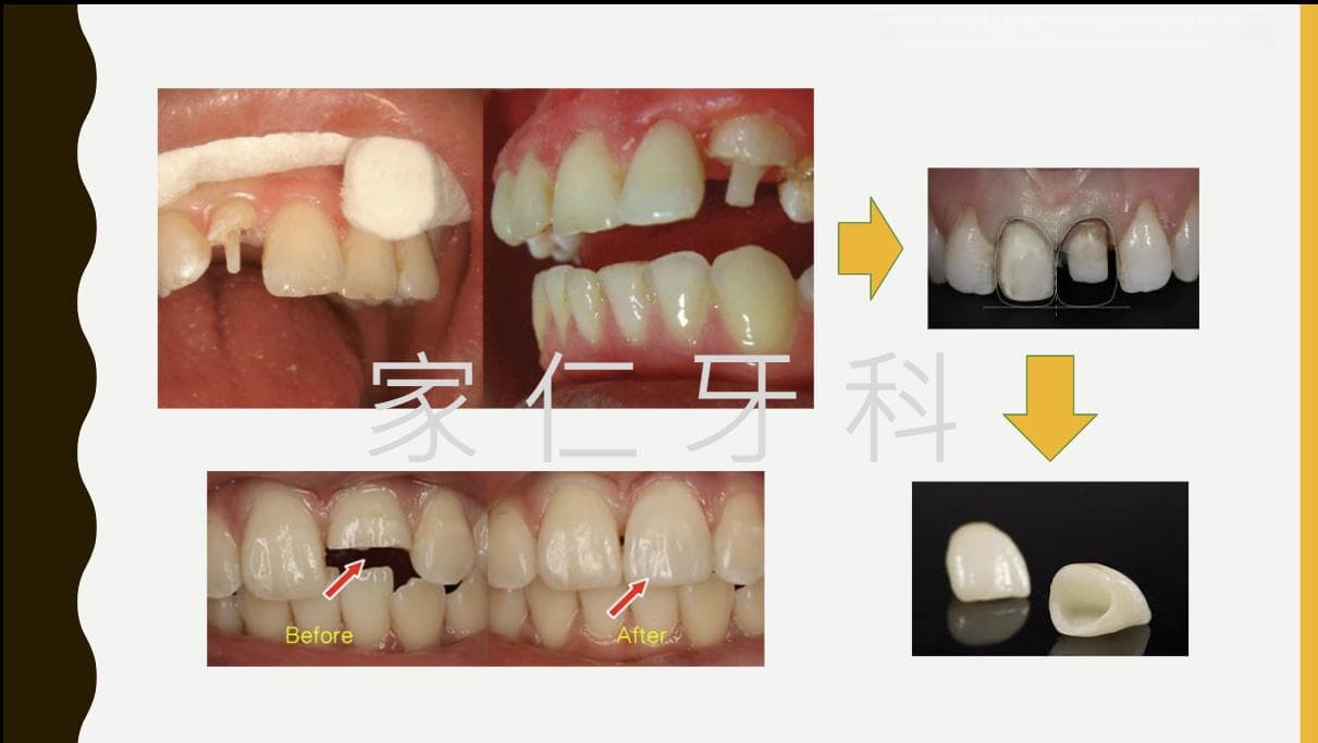 如何分辨成功与失败的根管治疗？