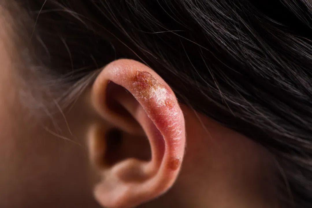 近期高发，这种病让人又痒又痛！最近返乡或去旅游的一定要注意（不是感冒）
