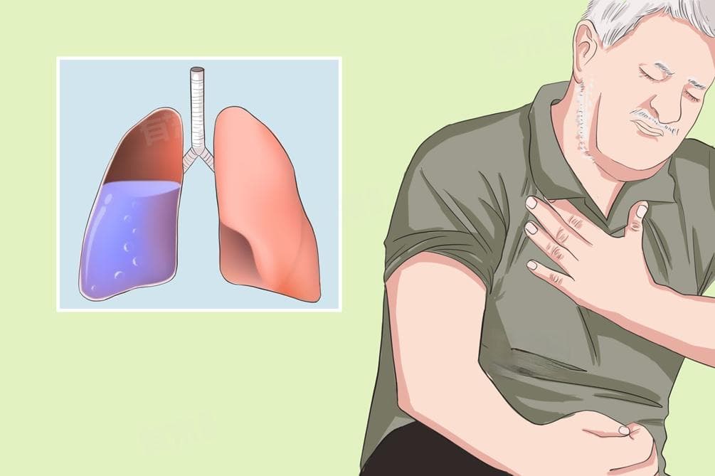 肺积水是什么症状