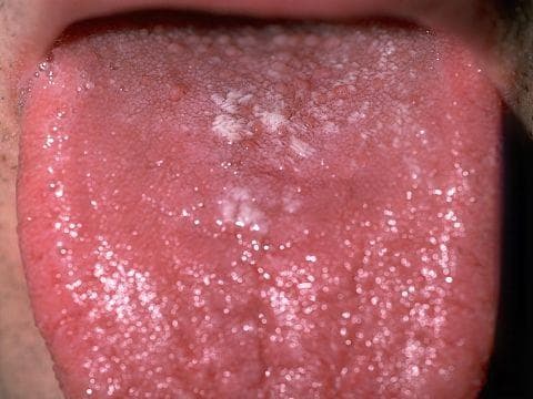 鹅口疮（口腔念珠菌病）：症状、风险人群及治疗方法全解析