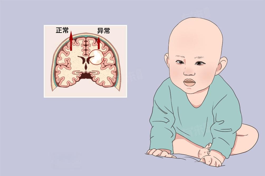 脑白质变性怎么恢复