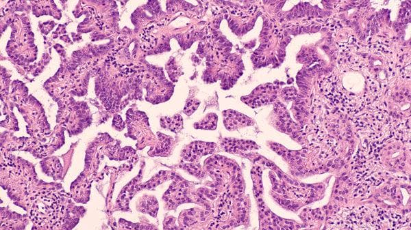 脾包膜玻璃样变：成因、症状与治疗全解析