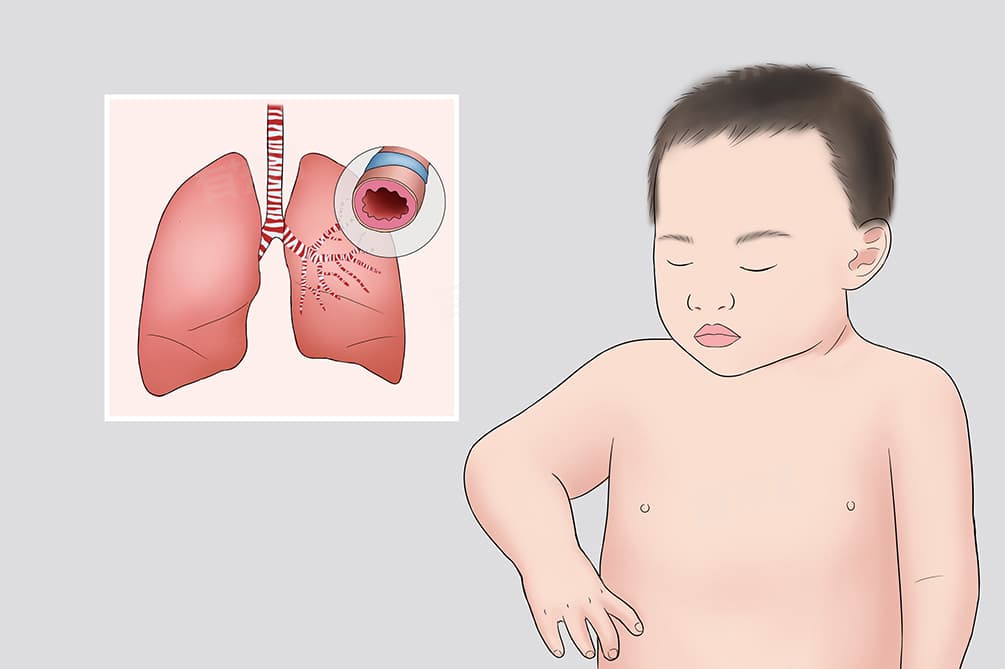 小孩毛细支气管炎症状及治疗方法