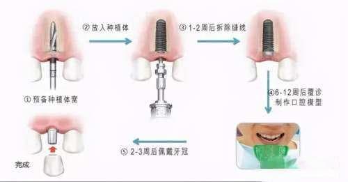 揭秘种植牙全部费用包括哪些:术前检查|一期二期三期治疗费用一网打尽,快来算算!