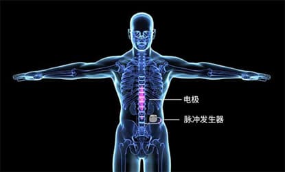糖尿病痛性神经病变患者如何解除疼痛？湘雅二医院成功开展脊髓电刺激器植入术