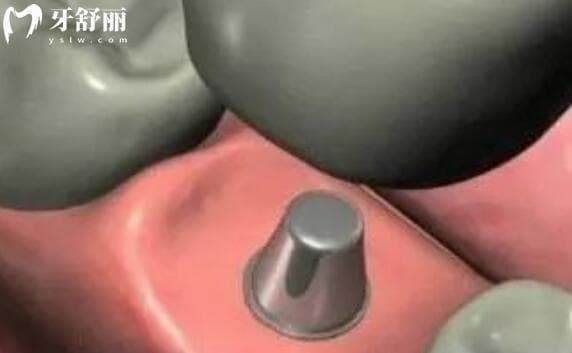 牙齿缺失十几年了还能种植牙么?牙医细说种牙修复三要素
