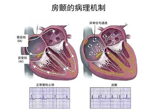 房颤的发生机制