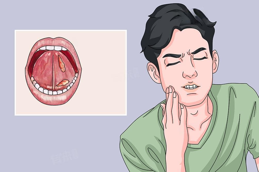 黏液腺囊肿是什么原因引起的