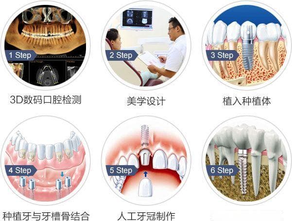 种植牙手术过程详解：从术前检查到术后护理