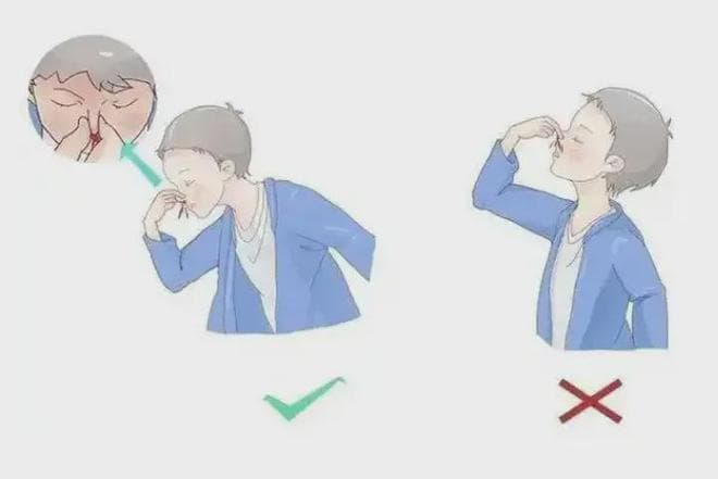 孩子经常流鼻血，家长要掌握这些科学止血方法！
