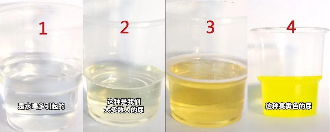 一文读懂：如何通过尿液判断肾脏健康状况