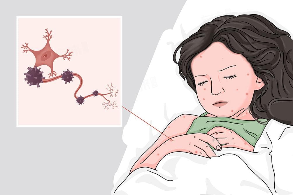 出水痘注意事项和禁忌
