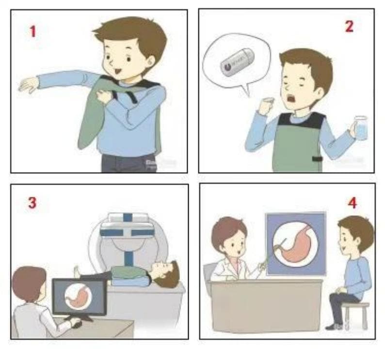 大圣磁控胶囊胃镜：胃癌早筛的新型利器