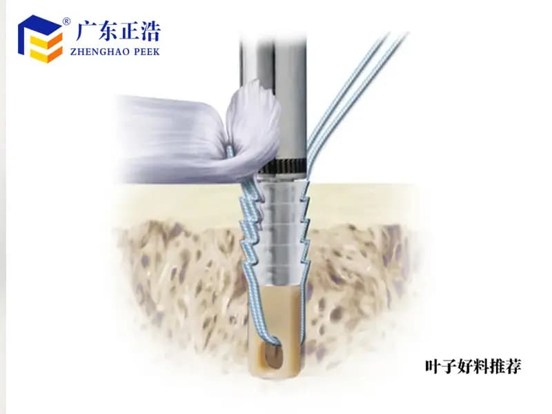 “PEEK材料：牙科手术，清晰视野助力”