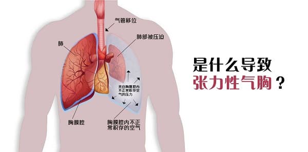 气胸 (爆肺)