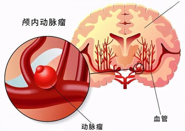 8旬老人眼睛剧痛查出颅内动脉瘤，医生成功拆除"不定时炸弹"