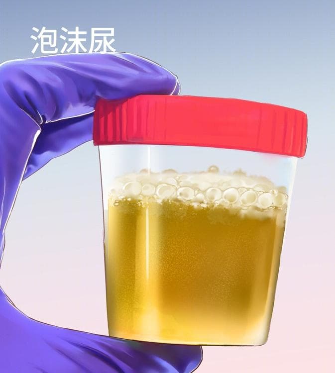 尿里有泡沫，久久不散？千万别大意！