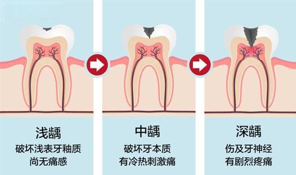 如何辨别浅龋、中龋及深龋的临床表现？龋齿的鉴别标准/治疗方法给到