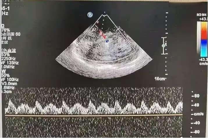 这些检查，让脑血管疾病无处遁形