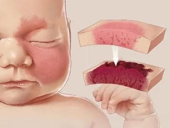 科学认识婴幼儿血管性皮肤病的激光治疗
