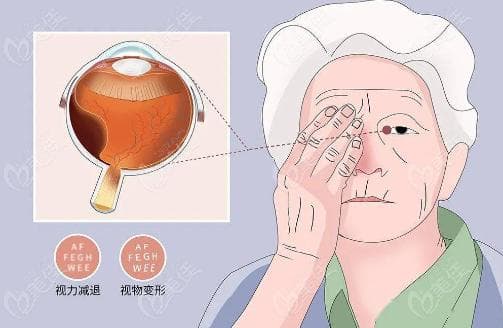 视网膜裂孔激光手术有后遗症吗？后遗症风险详述及术后长期成果分析