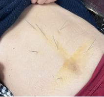 中医针灸治疗顽固性呃逆案例：七旬老人病情显著改善