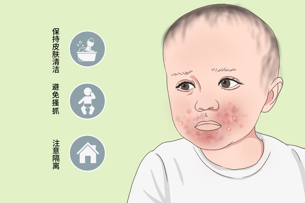脓疱疮：症状、诊断、治疗与预防全解析
