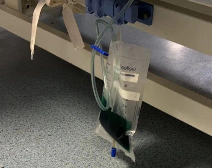 亚硝酸盐中毒致尿液青蓝，医生详解成因与预防要点