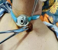 如何照顾气管切开的病人？