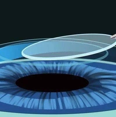近视激光手术——术前、术中、术后注意事项