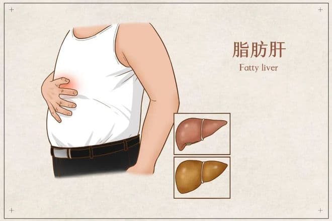 曙光医院汤抗美医师：脂肪肝的早期症状你有吗？