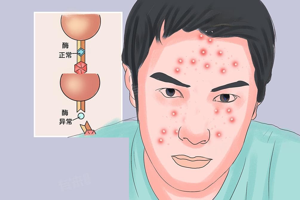 什么是卟啉病？这种罕见疾病的发病机制与日常管理全解析