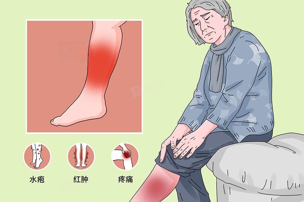 蜂窝组织炎是什么原因引起的