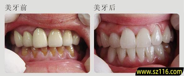 牙缝大怎么办？烤瓷牙牙缝处理与修复全攻略