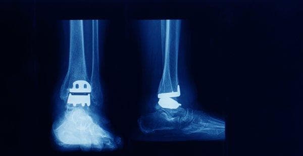右跟骨粉碎性骨折需要手术吗？