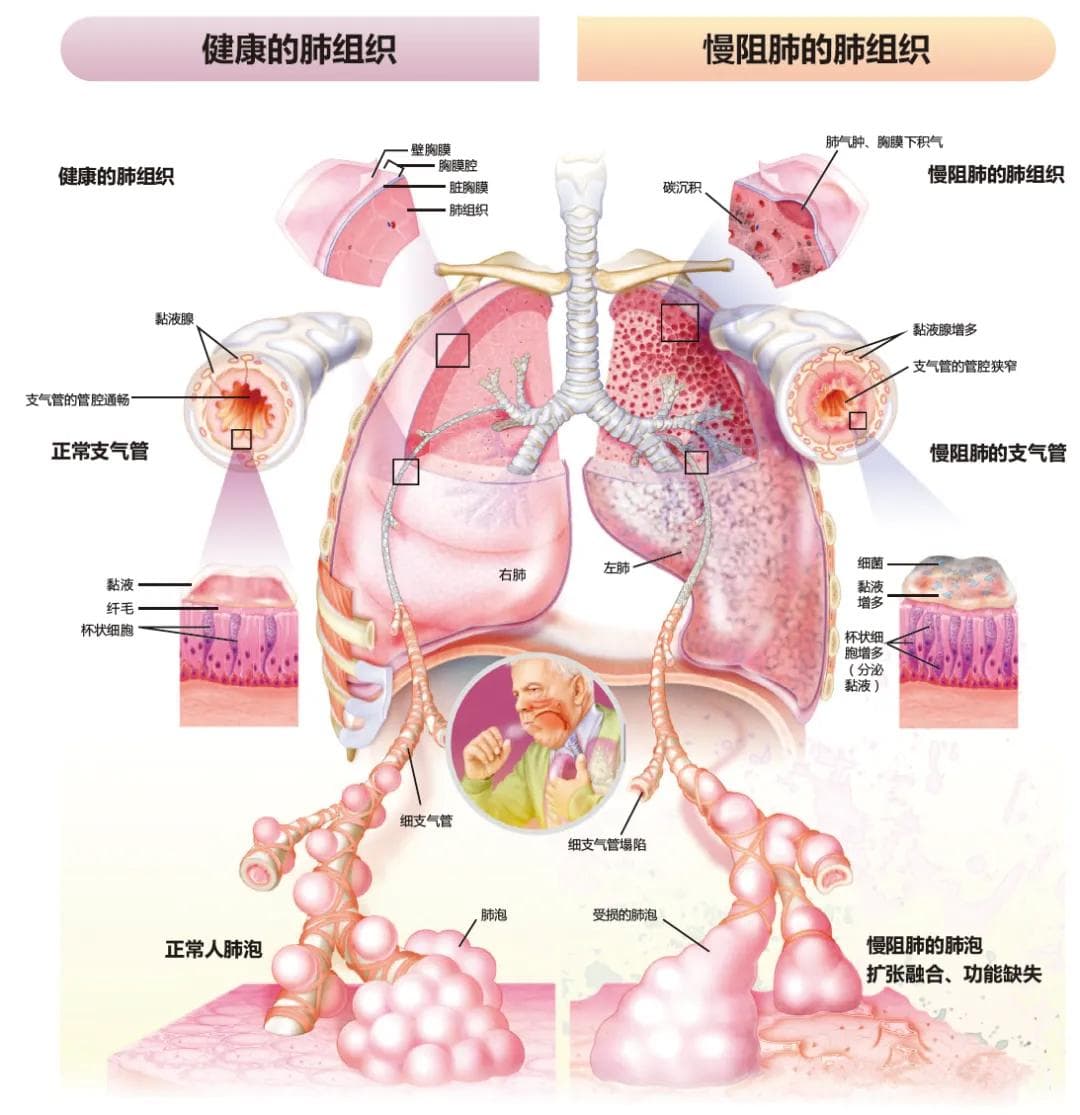 “不能呼吸的痛”要如何预防？Am J Clin Nutr ：类黄酮化合物给出答案