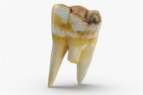 六号牙拔了能把七号牙牵引吗？揭秘六号牙缺失后的正畸新策略
