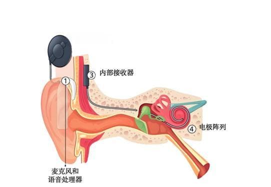 全国爱耳日|老年性聋如何重新听见清晰的世界？