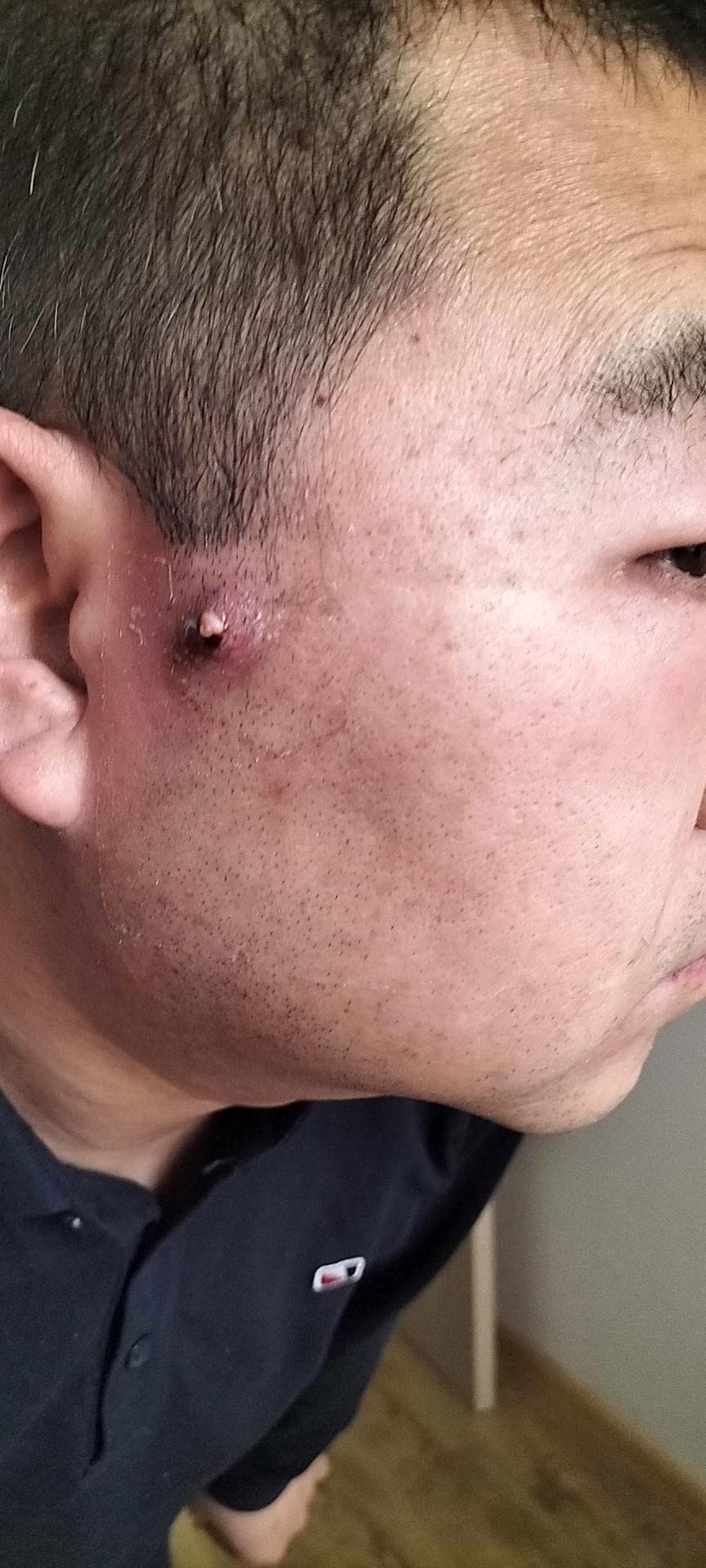 粉瘤化脓一般几天能好