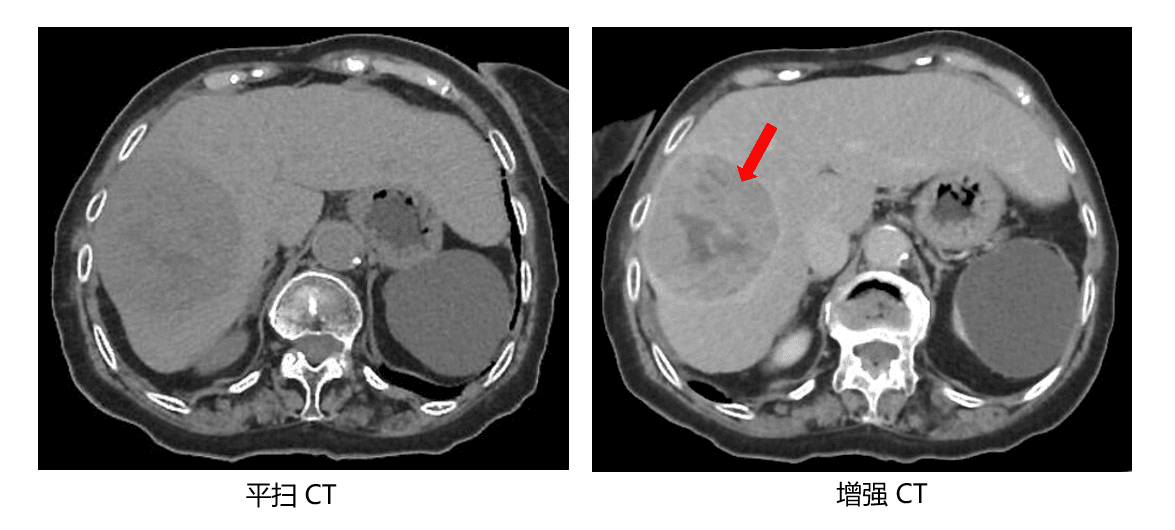 【科普】为什么医生要让你做增强CT？检查的注意事项有哪些？