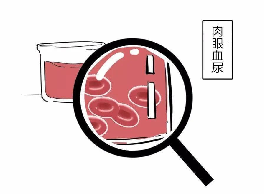 50个IgA肾病的重要常识，助你远离尿毒症