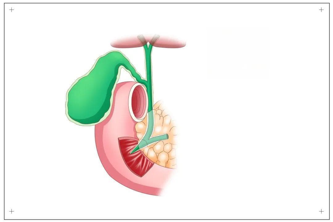 小小息肉，6年“熬”成癌，查出息肉一定要记得切