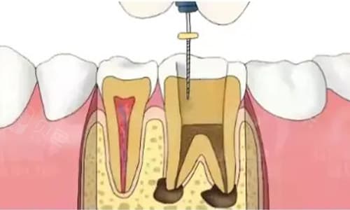口腔健康抉择：深入解析做根管治疗与拔牙的利弊，选择更适合你的治疗方式