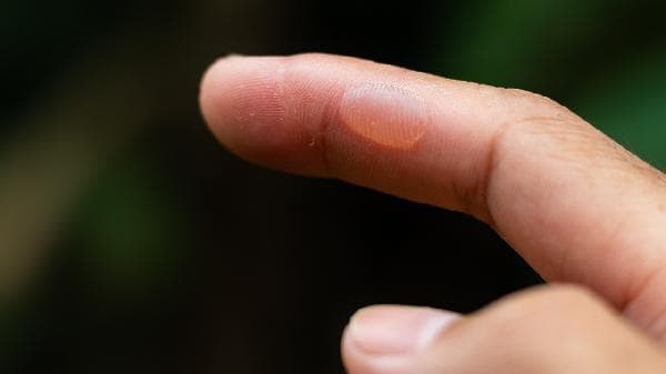 春天手部出现水泡和红点该如何处理