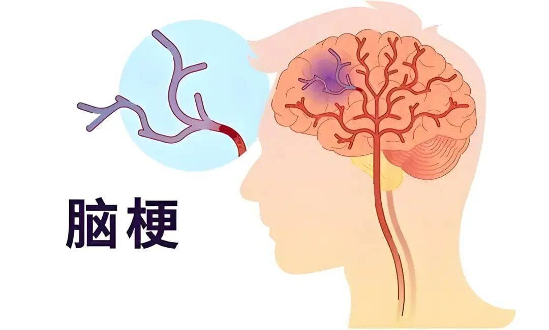 IPSC：脑梗治疗新曙光