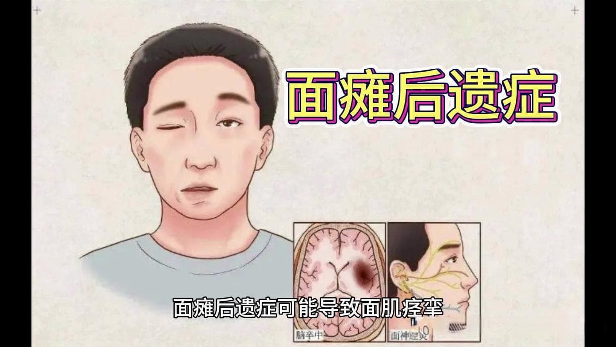 穴位埋线治疗面瘫后遗症